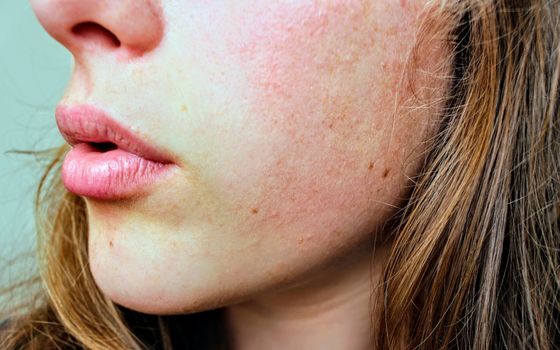 Acne in Astrology – Which Planet Causes Pimples & Skin Problems?